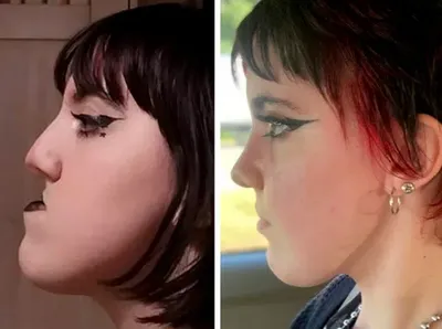 Foto Sebelum dan Sesudah Operasi Plastik Bikin Tercengang