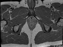 Begini Penampakan Alat Kelamin Pria yang Patah gegara Bercinta