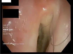 Efek Samping Merokok, Rambut Tumbuh di Tenggorokan Pria Ini