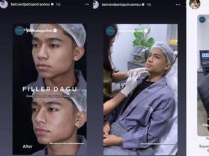 Betrand Peto Jalani Filler Dagu Biar Lebih Maskulin, Bagaimana Prosesnya? Betrand Peto Jalani Filler Dagu Biar Lebih Maskulin, Bagaimana Prosesnya?