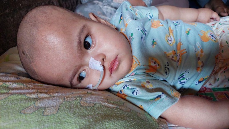 Cerita Pilu Balita Aisyah Penderita Hidrosepalus hingga Cerebral Palsy