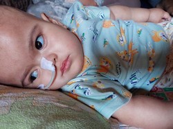 Cerita Pilu Balita Aisyah Penderita Hidrosepalus hingga Cerebral Palsy