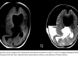 Kasus Langka Janin Kembaran Terjebak dalam Kepala Balita