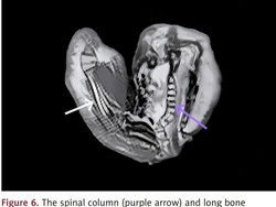 Awal Mula Temuan Janin Berukuran 18 Cm di Kepala Anak Berusia 1 Tahun