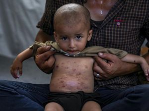 Nasib Anak-anak di Gaza Kini Dihantui Penyakit Kulit Menular