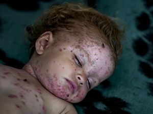 Nestapa Anak-anak Gaza Diserang Penyakit Menular