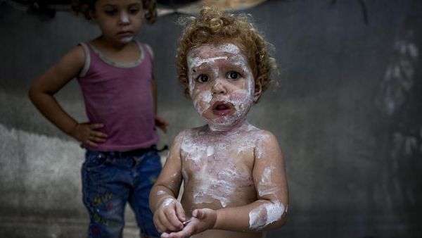 Anak-anak di Gaza Mulai Menderita Penyakit Kulit Akibat Kondisi Kamp Buruk