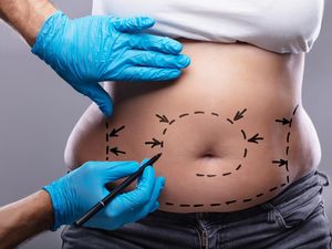 Apa Itu Sedot Lemak dan Inovasi Teknologinya