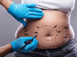 Sedot Lemak Berujung Petaka, IDI Angkat Bicara soal Dokter-Klinik Berkualitas