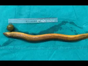 Merinding! Dokter Keluarkan Belut Besar dari Usus Manusia Merinding! Dokter Keluarkan Belut Besar dari Usus Manusia