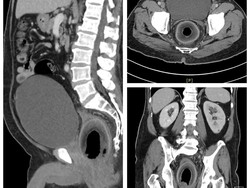 Ngilu! Dokter Keluarkan Kelapa yang Nyangkut di Dubur Pria Taiwan