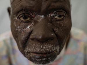 Kongo Darurat Cacar Monyet, Tewaskan 548 Orang