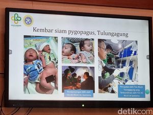 RSU Soetomo Catat 26 Anak Kembar Siam Berhasil Dipisahkan dan Survive RSU Soetomo Catat 26 Anak Kembar Siam Berhasil Dipisahkan dan Survive