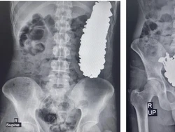 Penampakan 452 Benda Logam Bersarang di Perut Pria di Iran, Ada Mur-Baut