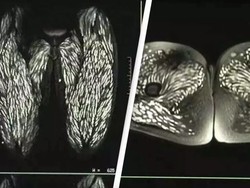 Sering Makan Daging Babi Mentah, Tubuh Wanita Ini Penuh Parasit