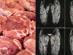 Ngeri! Tubuh Wanita Ini Dipenuhi Parasit Gegara Makan Daging Babi Mentah