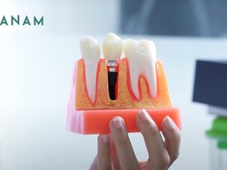 Tanam Gigi Jadi Solusi Terkini untuk Atasi Gigi Ompong