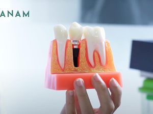 Tanam Gigi Jadi Solusi Terkini untuk Atasi Gigi Ompong Tanam Gigi Jadi Solusi Terkini untuk Atasi Gigi Ompong