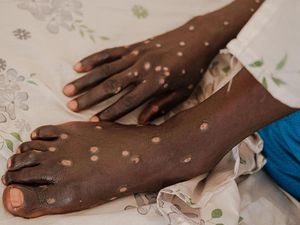 Kisah Para Penyintas Berjuang untuk Sembuh dari Mpox