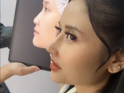 Riyuka Bunga Kemarin Heboh soal Suami, Kini Bikin Pangling Usai Operasi Hidung