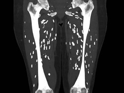 Kaki Pasien Ini Terinfeksi Cacing Pita gegara Makan Babi Tak Matang