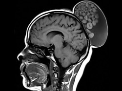 Ngeri! Wanita Ini Punya Benjolan Seperti Sanggul di Kepala, Isinya Ternyata Kista