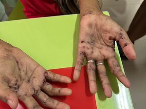 Satu Warga Palembang Jadi Suspect Monkey Pox