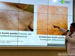 RSHS Pernah Tangani 2 Pasien Mpox Tahun 2023