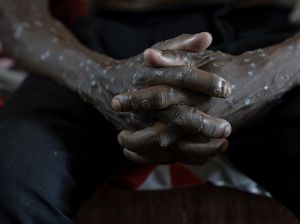 Makin Ngeri, Kematian Mpox Cacar Monyet di Afrika Sudah Lebih dari 800 Kasus Makin Ngeri, Kematian Mpox Cacar Monyet di Afrika Sudah Lebih dari 800 Kasus