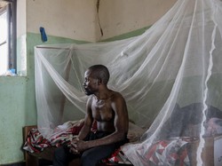 Kasus Mpox Ngegas Lebih dari 500 Persen, Pakar Bicara Risiko Pandemi