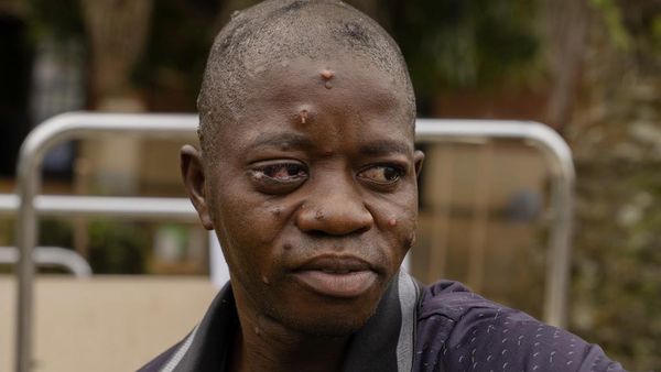 Potret Kondisi Pasien Mpox di Kongo, Sudah Ada 17 Ribu Orang Terinfeksi