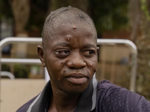 Potret Kondisi Pasien Mpox di Kongo, Sudah Ada 17 Ribu Orang Terinfeksi Potret Kondisi Pasien Mpox di Kongo, Sudah Ada 17 Ribu Orang Terinfeksi