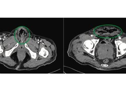 Penis Pria Usia 65 Tahun Ini Harus Diamputasi gegara Membusuk, Begini Sebabnya