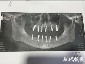 Viral di China, Pria Meninggal Seusai Cabut 23 Gigi dalam Sehari Viral di China, Pria Meninggal Seusai Cabut 23 Gigi dalam Sehari