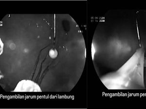 Detik-detik Dokter Senior FKUI Keluarkan Jarum Pentul dari Lambung Detik-detik Dokter Senior FKUI Keluarkan Jarum Pentul dari Lambung