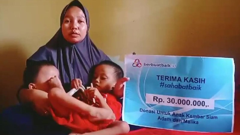 Kondisi Kembar Siam Adam dan Malika Membaik Berkat Sahabat Baik