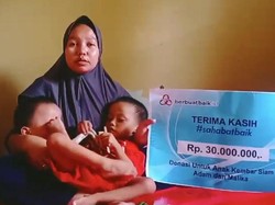 Kondisi Kembar Siam Adam dan Malika Membaik Berkat Sahabat Baik