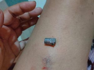 Jadi Korban Peluru Nyasar, Paha Warga Gubeng Surabaya Memar