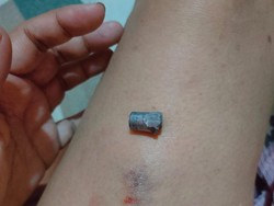 Jadi Korban Peluru Nyasar, Paha Warga Gubeng Surabaya Memar