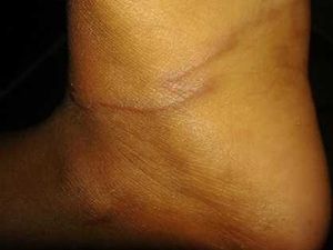 Kala Cacing Parasit Bersarang di Kaki Bocah Tak Bersandal Kala Cacing Parasit Bersarang di Kaki Bocah Tak Bersandal
