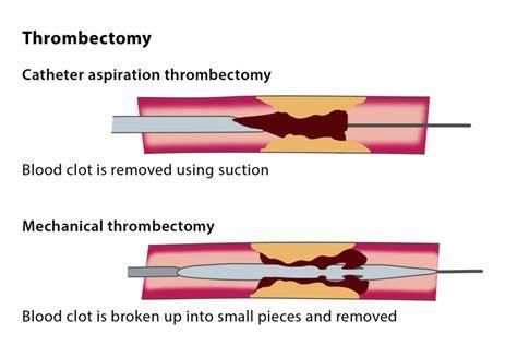 Contoh prosedur Trombektomi