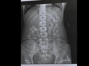 Penampakan Isi Perut Wanita Afrika Selatan, Penuh Narkoba Selundupan