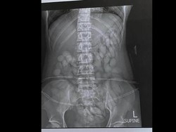 Penampakan Isi Perut Wanita Afrika Selatan, Penuh Narkoba Selundupan