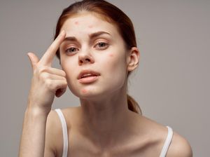 6 Cara Ampuh Menghilangkan Jerawat dalam Semalam 6 Cara Ampuh Menghilangkan Jerawat dalam Semalam