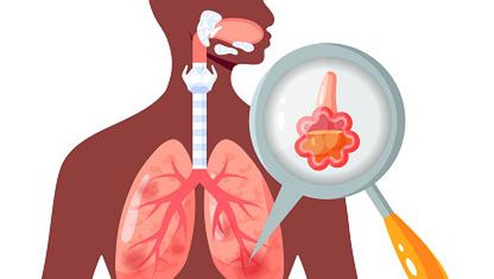 Ilustrasi paru-paru berair atau pneumonia.