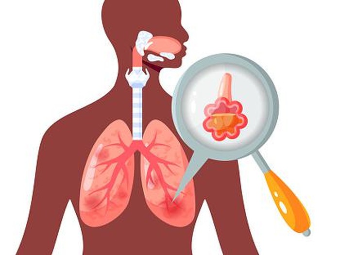 Ilustrasi paru-paru lembap atau pneumonia. Ilustrasi paru-paru lembap atau pneumonia.