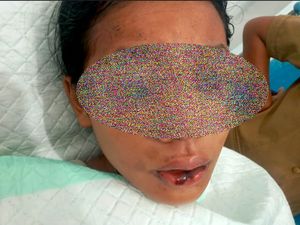 Siswi SMP di Lembata yang Disiram Air Keras Dirujuk ke RSUP Prof Ngoerah Bali