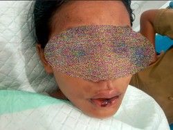 Mata Siswi SMP Disiram Air Keras oleh Sepupu karena Cinta Tak Direspons