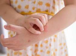 Eksim Bukan Penyakit Menular, Ini Penyebab dan Cara Mengatasinya