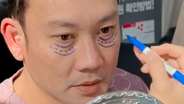 7 Foto Denny Sumargo Operasi Kantung Mata di Korea, Begini Hasilnya